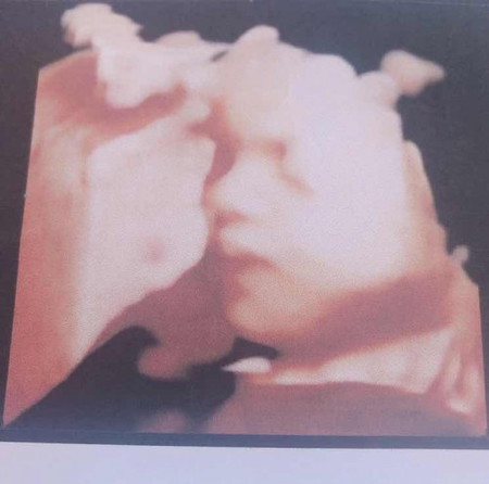 30week2d กำหนดคลอด25กันยา
