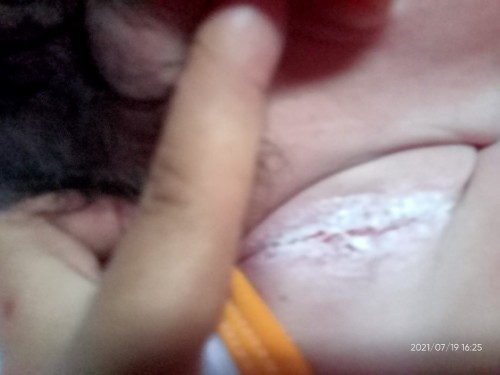 May rashes sa leeg