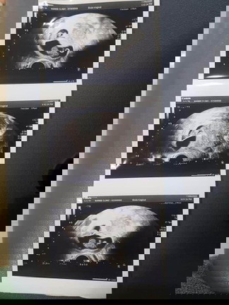 นารีคลินิก รีวิวทำ เด็กแฝด cisi 10ครั้งกว่าจะมีวันนี้