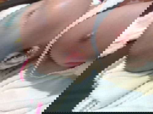 Bekas suntikan bernanah