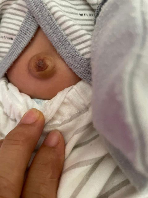 pusar bayi menonjol saat bayi ngeden/ngejan, rewel, dan kembung