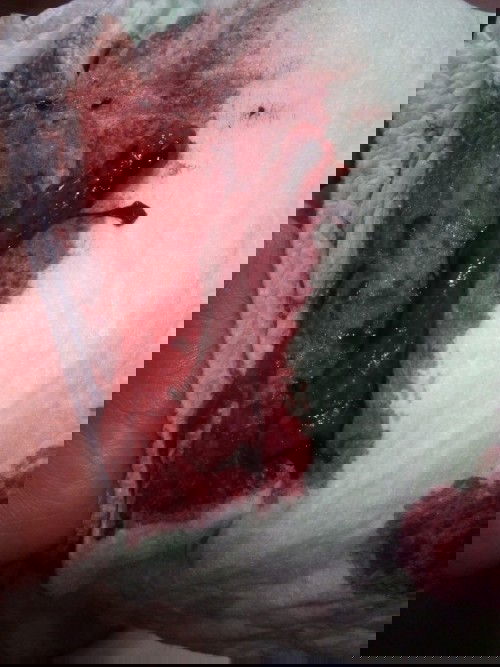 ครั้งนึงเคยมีก้อนเลือดแบบนี้