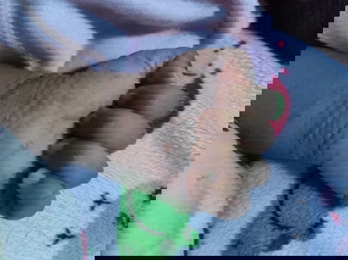 Penyakit kulit pada bayi