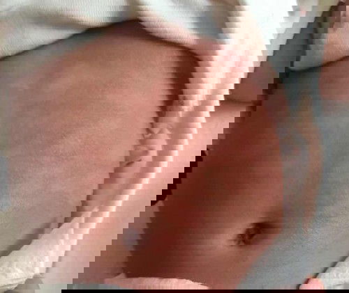 สอบถามเรื่องผื่นของทารก