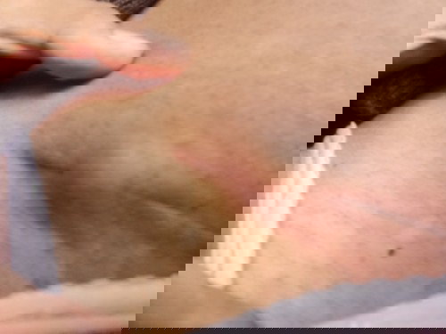 Benjolan setelah operasi