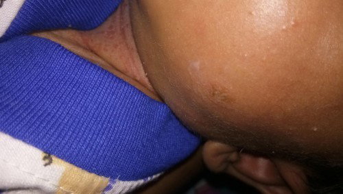 Pipi anak tumbuh buletan bentol