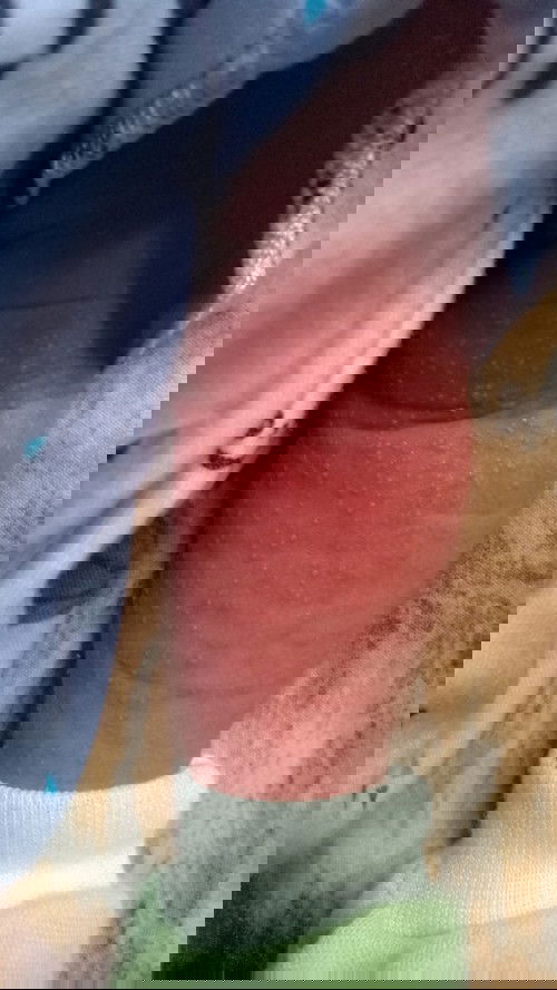 Biang keringat di tangan bagian dalam parah bgt...