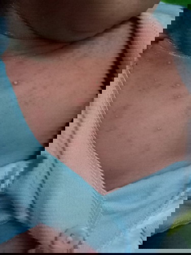 banyak bintik merah pada bayi