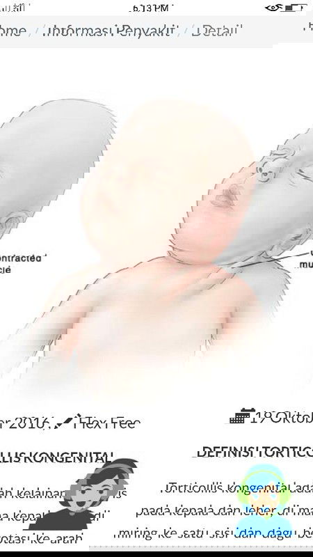 Tortikolis pada bayi