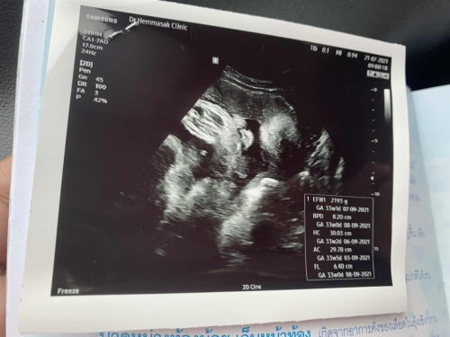 แม่ๆค่ะ 33 week น้ำหนัก 2193 น้อยไปมั้ยค่ะ
