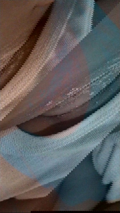 Ruam leher baby 3,5 bulan BB 8,5 KG