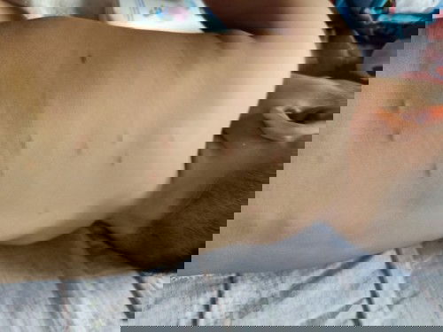 มันคือตุ่มอะไรคะ