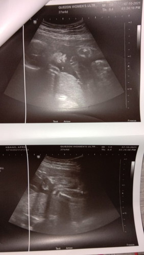 Ano po kaya gender ni baby
Wala po kasing nakalagay 😅
Kung girl o boy.
#1sttimemom
#excited27weeks