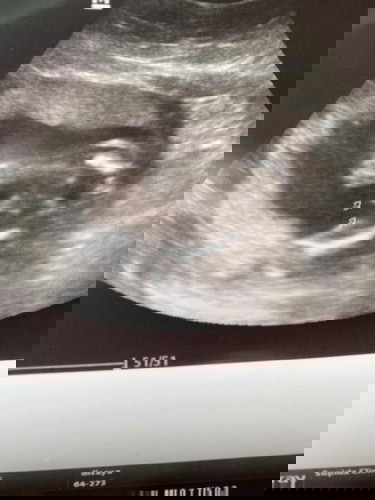 อัลตราซาวด์มาวันนี้