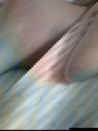 มีตุ่มสีขาวที่เท้า