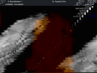 ตั้งครรภ์เบาหวานน้องตัวโตเกินเกณฑ์มาก😢 กังวลกลัวว่าจะคลอดเองไม่ไหว 36W 3,500 กรัม