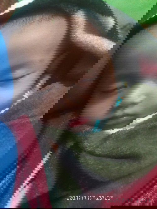 Guamen / sariawan bayi