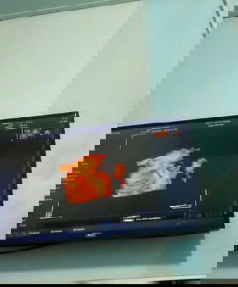 USG 4D apa bisa liat kondisi janin