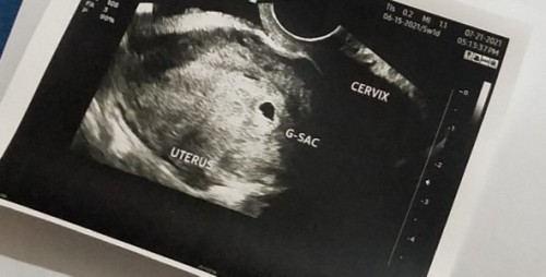 Gestational Sac Near Cervix