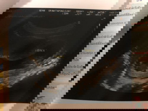 ขอวิธีดูแลตัวเองของคุณแม่ท้องแฝดหน่อยค่ะ