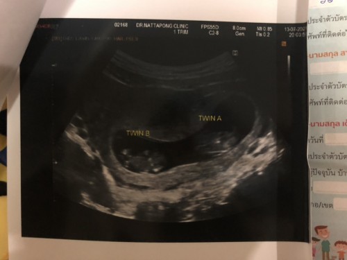 ขอวิธีดูแลตัวเองของคุณแม่ท้องแฝดหน่อยค่ะ