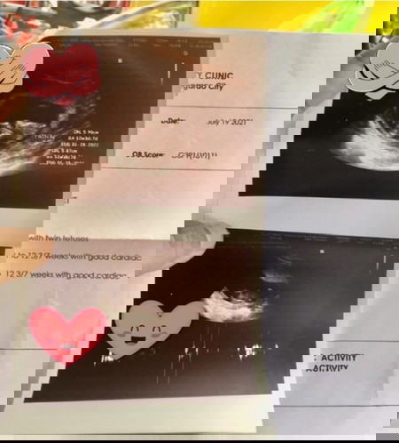 May nanganak na ba ng twins dto na normal? Ung hindi need macs 😅😅