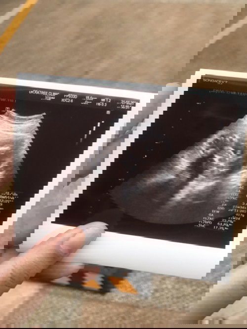 แม่ๆคนไหนฝากท้องรพ.รัฐแล้วซาวด์อายุครรภ์ไม่ตรงกับตอนไปซาวด์ที่คลินิกไหมค่ะ