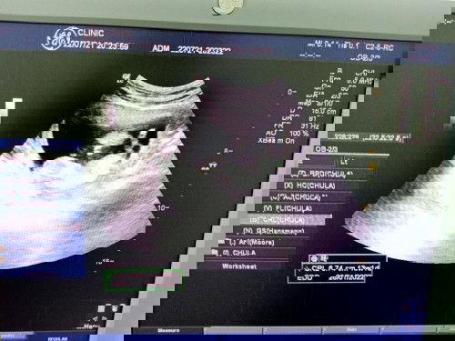 แม่ท้องเห่อลูก