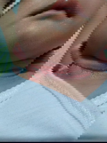 Ano po ba gamot sa leeg na may sugat at medyo nangangamoy at namamaga na po. Salamat