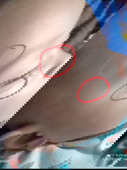 Bintik diwajah anak.