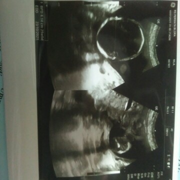 Udah USG 2x tapi BBJ ngk di kasih tau jadi worry bngt Bun😥