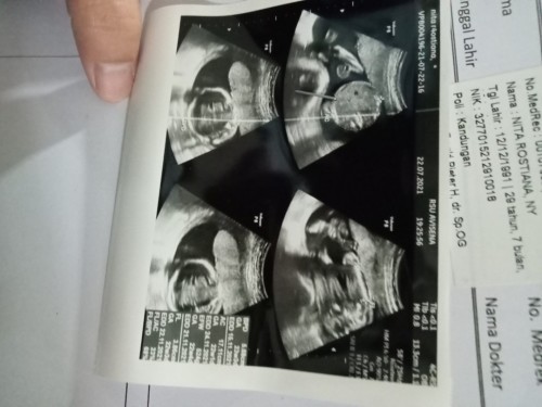 Assalamualaikum bunda bunda mau tanya klo fto usg ini kira2 anak saya jenis kelamin nya cwe apa cwo