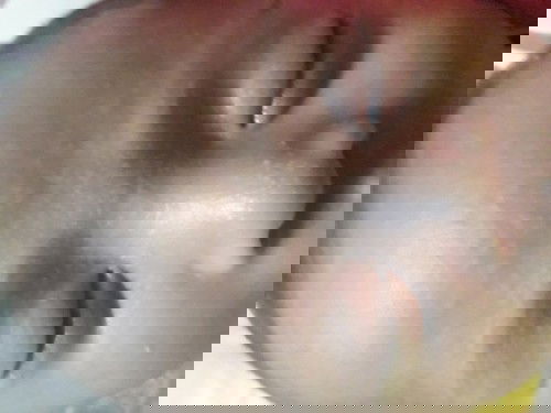 Acne sa face ni baby