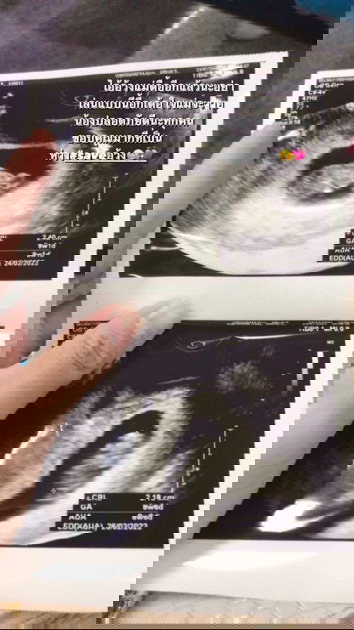 9week ท้องแรก💖