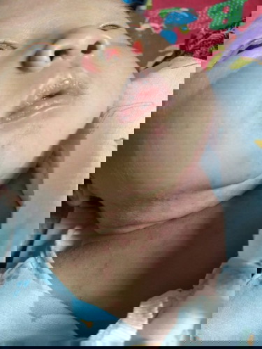 มีผื่นแดงขึ้น