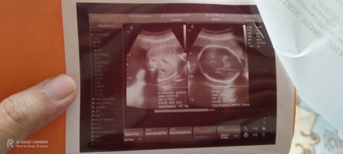 Baby blm masuk panggul