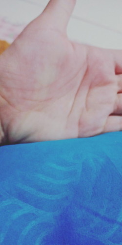 Gatal di telapak tangan dan kaki