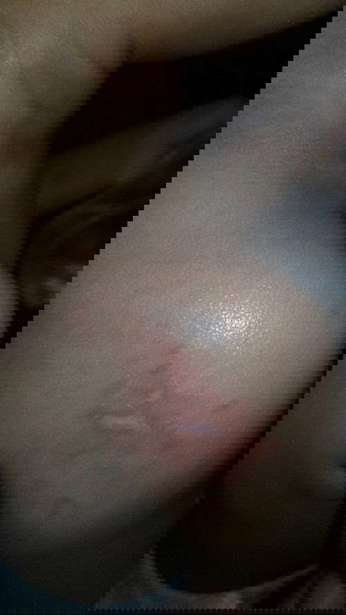 Luka pada anak 17 bulan