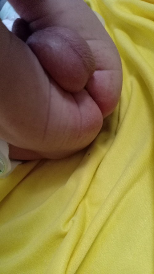 Ruam popok :(