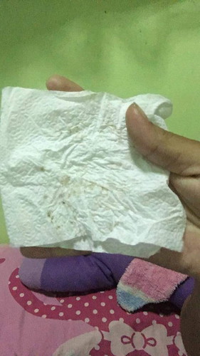 ลานนมเป็นตุ่มหนอง