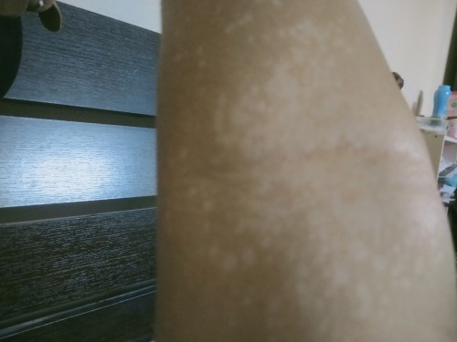 แม่ๆบ้านไหนตั้งครรภ์แล้วเป้นแบบนี้บ้างคะไม่คันแต่เป้นเหมือนเกลื้อนเลยค่ะ