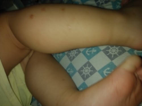 Kagat ng lamok at langgam