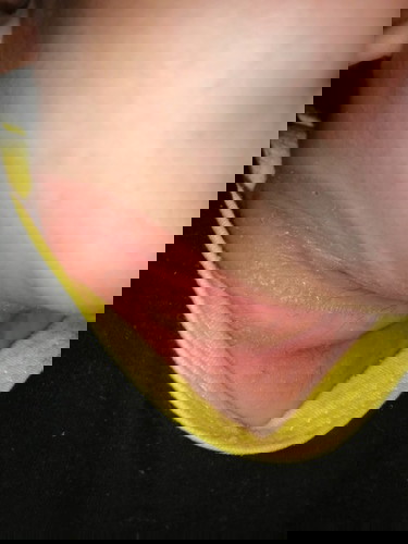 Rashes Sa Leeg Ni Baby