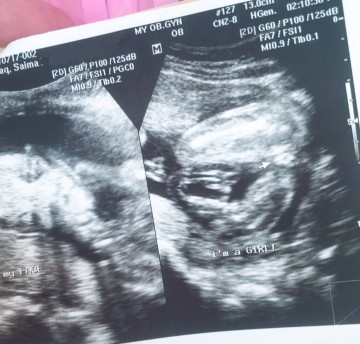 22 week ultrasound