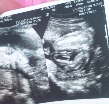 22 week ultrasound