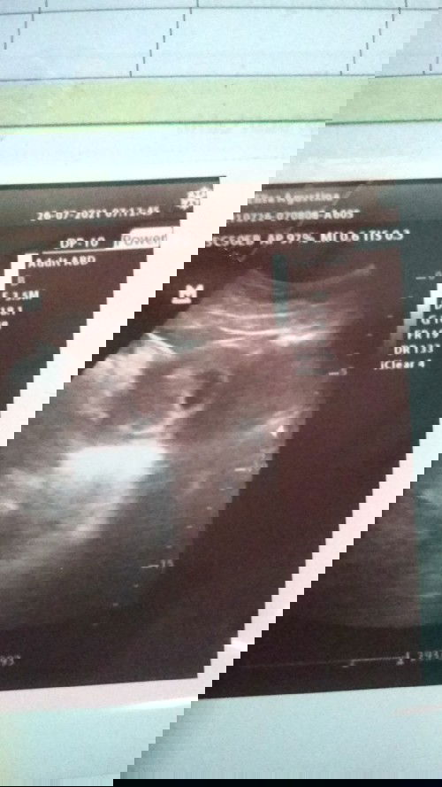 Usg 8week janin belum terlihat jelas