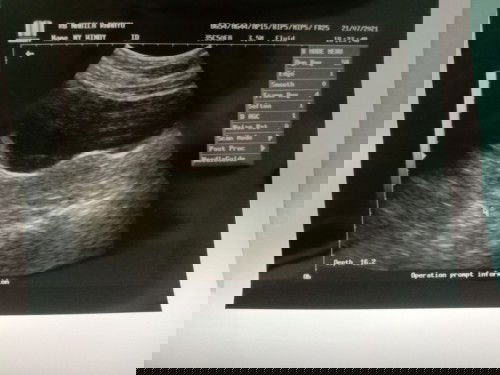 Hasil usg belum terlihat