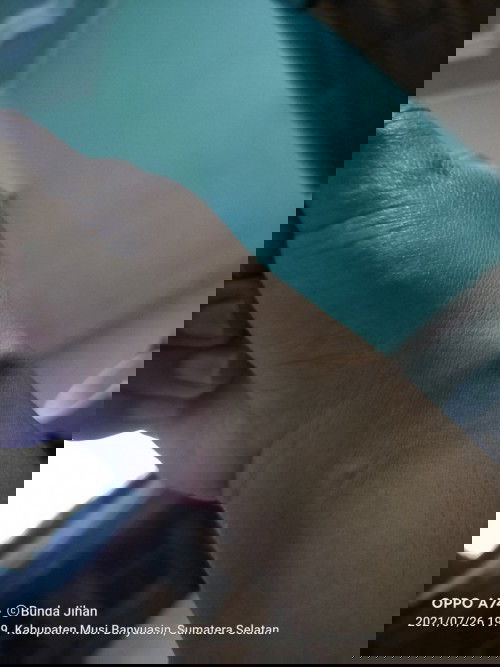 Pembengkakan pada pergelangan tangan