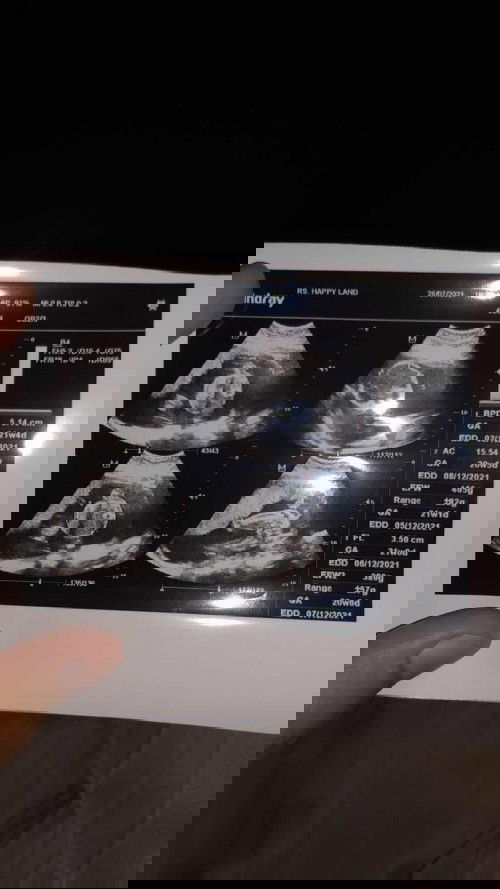 21 week 4days jenis kelamin Perempuan