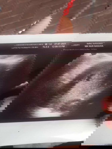 Hi nak tanya , masa scan doctor kata high change pregnancy tak jadi . Dia kata scan tak cantik . Is it normal?
